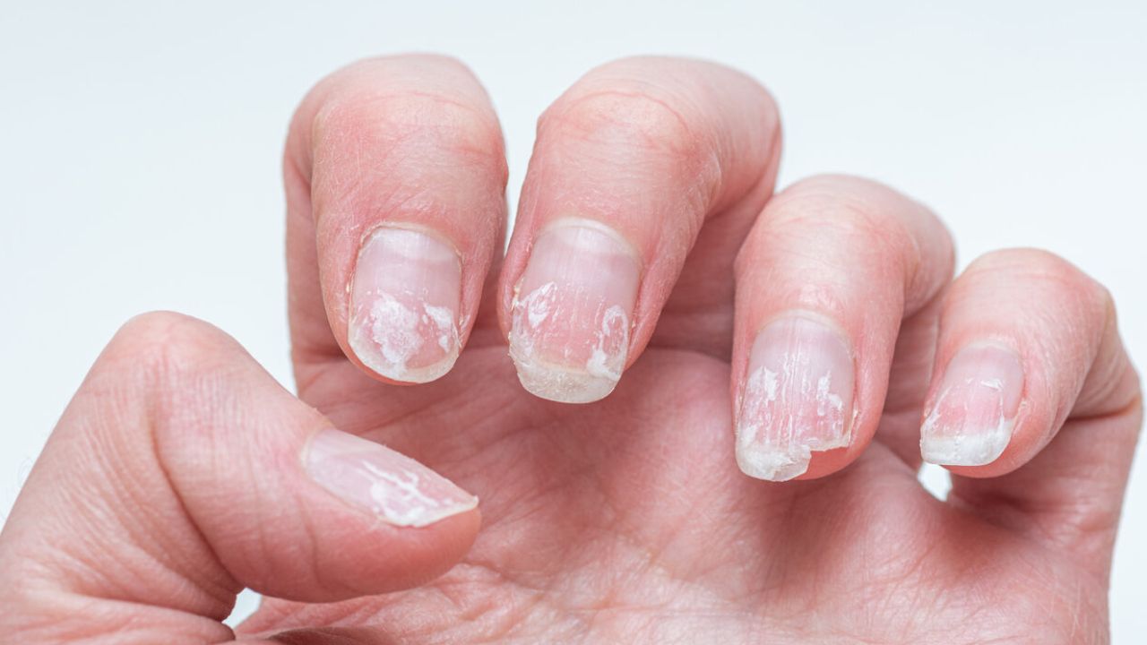 Identificando os Sinais: Como Saber se é Fungo Mesmo? - inspiração 2