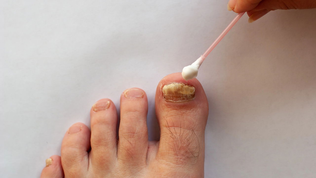 Antifúngicos Tópicos: Quando o Remédio de Farmácia é a Melhor Opção - inspiração 2