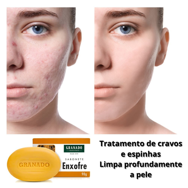 benefícios do sabonete de enxofre para acne