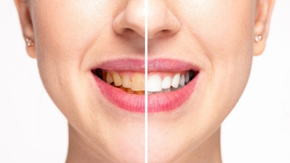 1. Clareamento Dental Caseiro Supervisionado vs. Produtos de Venda Livre: Qual a Melhor Opção?
2. Os Perigos Escondidos das Receitas Caseiras para Clarear os Dentes
3. Guia Completo: Como Manter os Dentes Brancos com Hábitos Saudáveis
4. Clareamento Dental: Entenda os Diferentes Tipos e Suas Eficácias
5. Dicas de Dentistas: Como Clarear os Dentes em Casa com Segurança