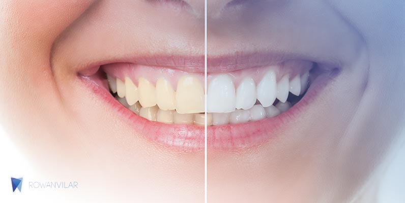 1. Clareamento Dental Caseiro Supervisionado vs. Produtos de Venda Livre: Qual a Melhor Opção?
2. Os Perigos Escondidos das Receitas Caseiras para Clarear os Dentes
3. Guia Completo: Como Manter os Dentes Brancos com Hábitos Saudáveis
4. Clareamento Dental: Entenda os Diferentes Tipos e Suas Eficácias
5. Dicas de Dentistas: Como Clarear os Dentes em Casa com Segurança