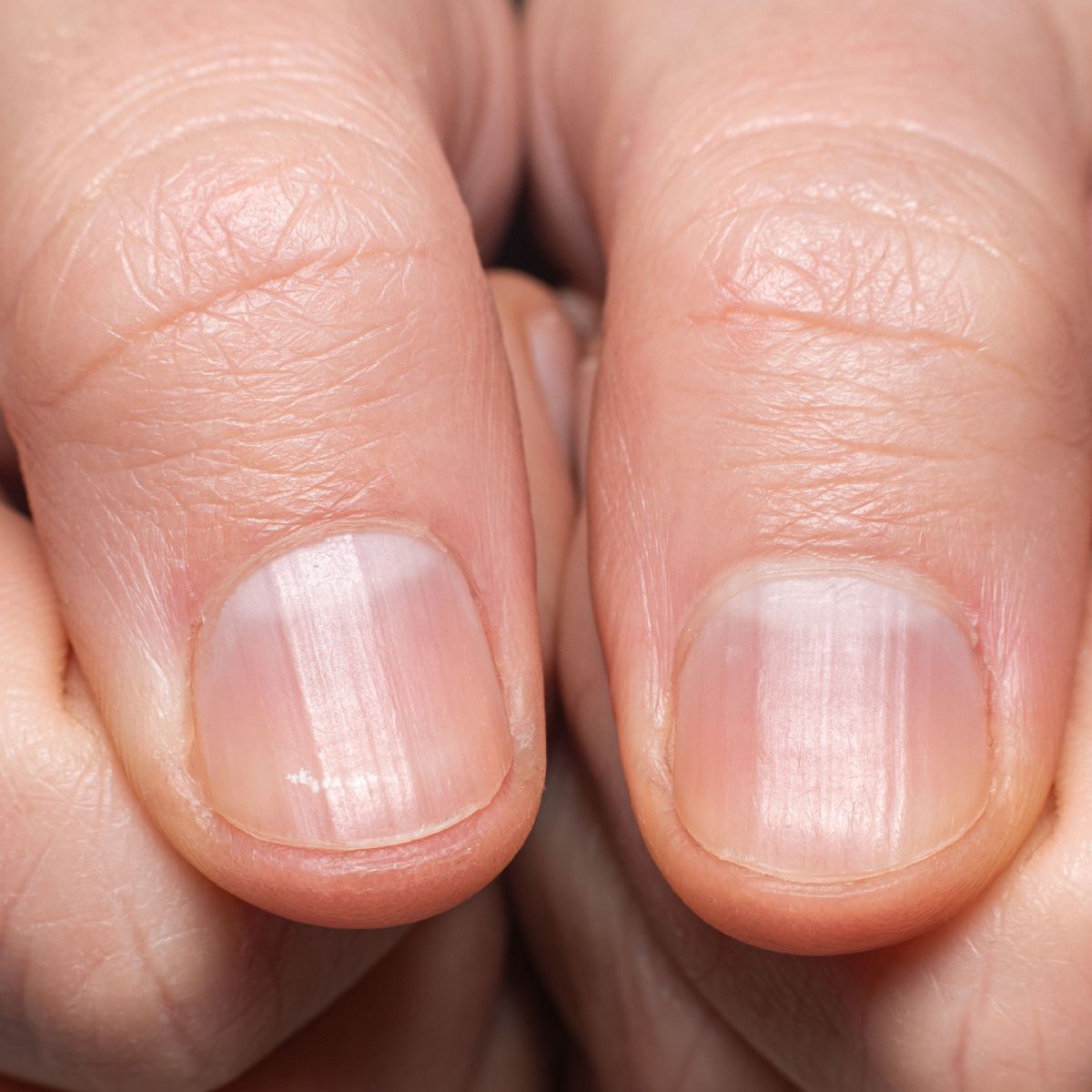 5 Mitos e Verdades sobre Unhas Estriadas