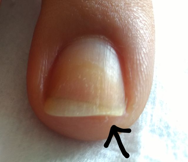 Como a Alimentação Afeta as Estrias nas Unhas