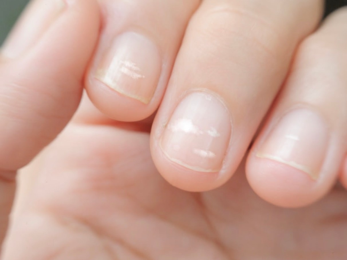 como cuidar de unhas com manchas brancas