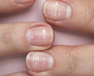 5 ideias de títulos:
1. Manchas Brancas nas Unhas: Guia Completo de Causas e Tratamentos
2. Unhas com Manchas Brancas: O Que Elas Significam e Como Resolver?
3. Mitos e Verdades Sobre Manchas Brancas nas Unhas
4. Rotina de Cuidados Essenciais para Unhas Livres de Manchas Brancas
5. Quando Manchas Brancas nas Unhas Indicam um Problema de Saúde?