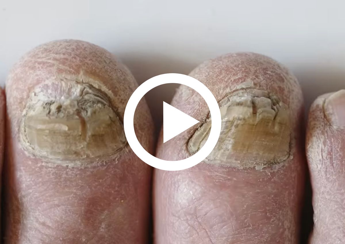 Quando os tratamentos caseiros não são suficientes para micose de unha?