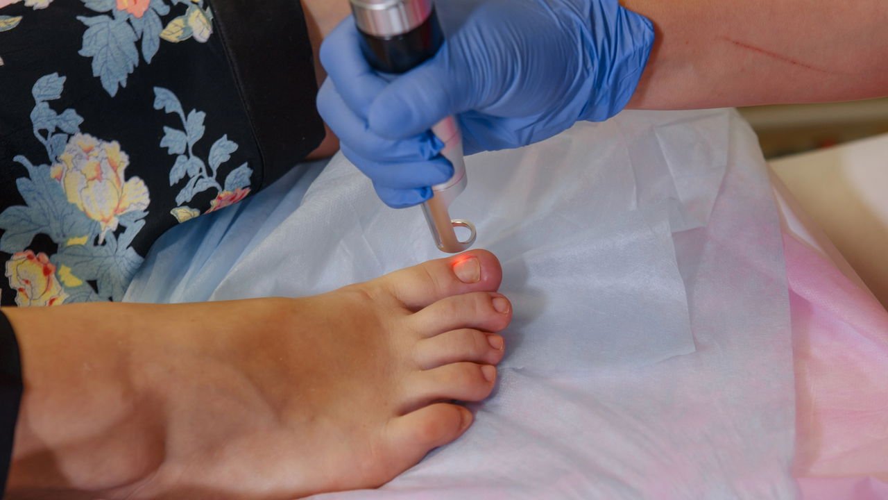 como cuidar de unhas com micose caseiro