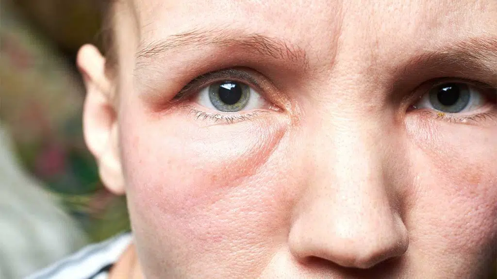 como diminuir o inchaço do rosto ao acordar