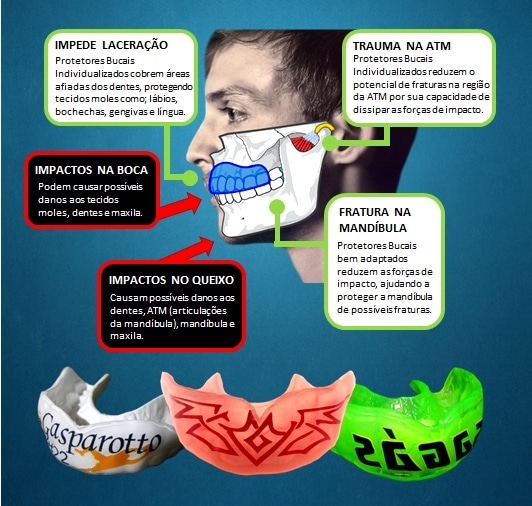 Guia Completo: Como Escolher o Protetor Bucal Perfeito para Cada Esporte