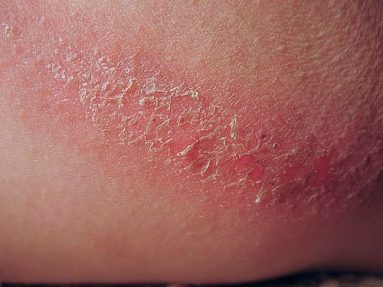 como evitar assaduras em trilhas longas