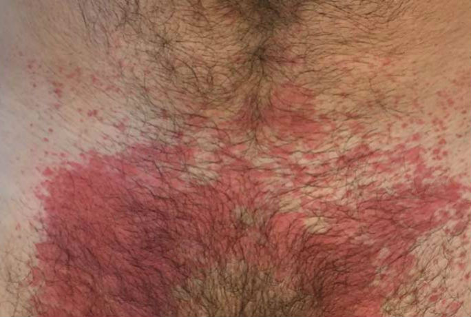 como evitar assaduras em trilhas longas