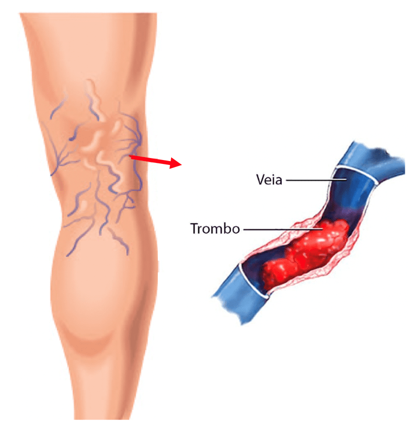 Como a Hidratação e a Dieta Afetam a Circulação das Pernas