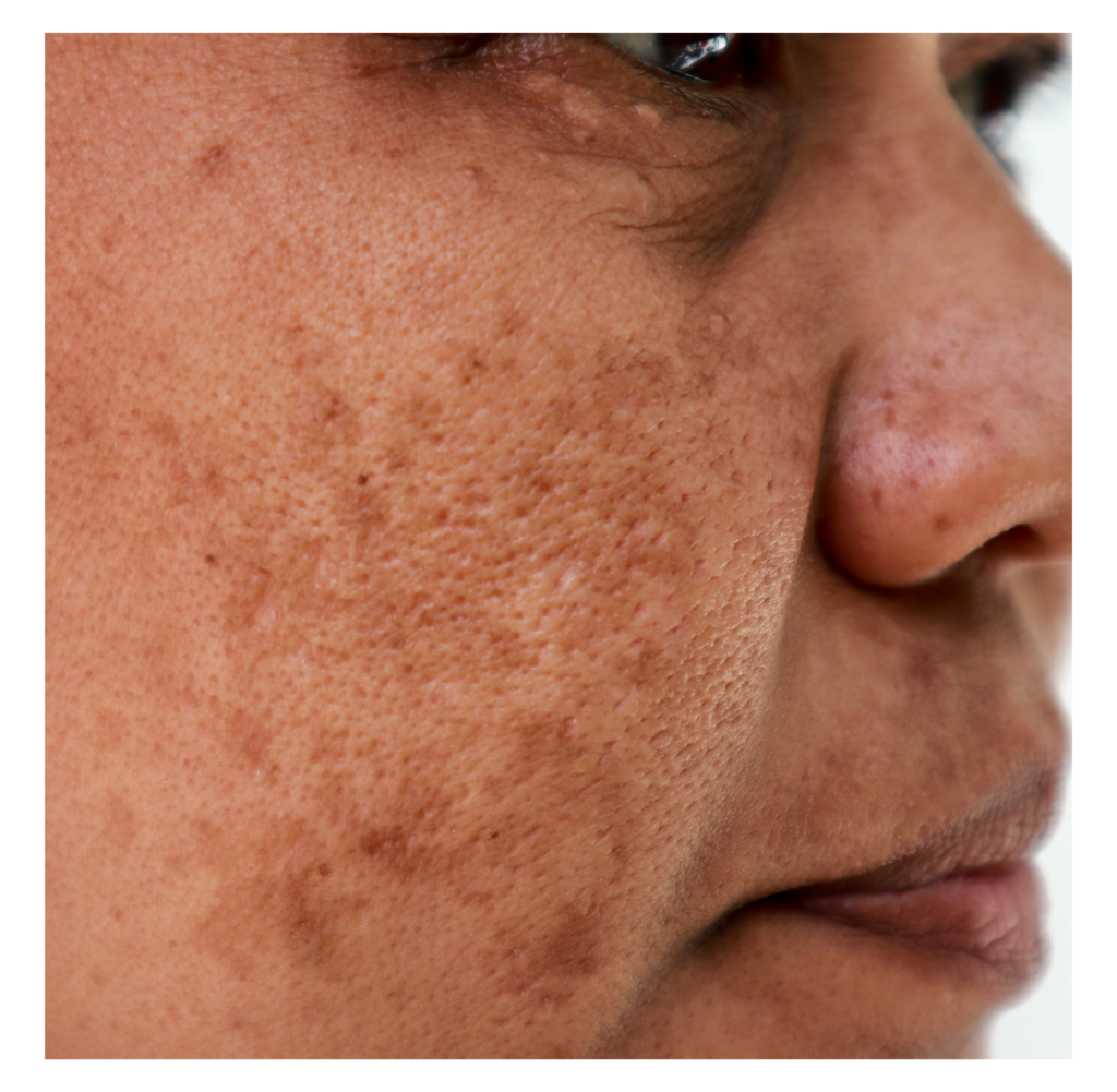 como tirar manchas de sol do rosto caseiro