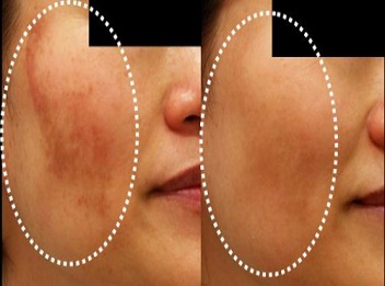 Como Usar Ácido Kójico com Segurança