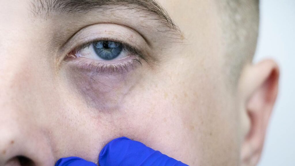 como tirar olheiras de choro rápido