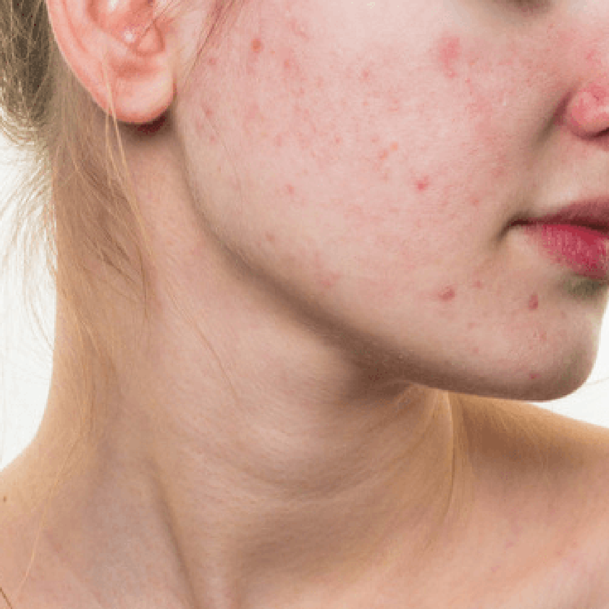 Como o Estresse Afeta sua Pele: Dicas para Gerenciar a Acne