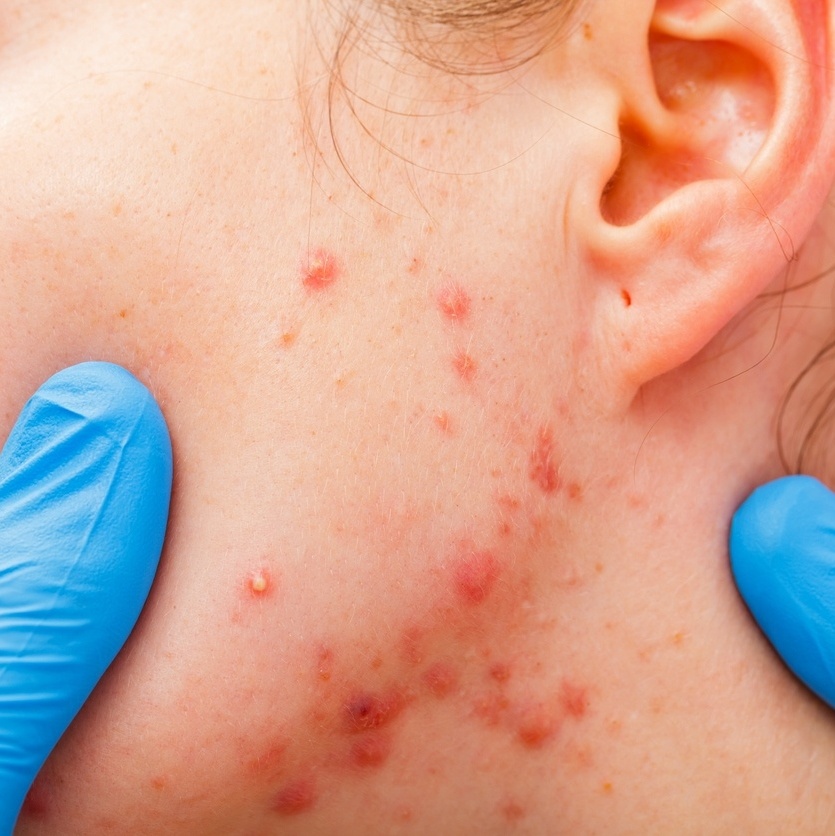 Óleos Essenciais: Aliados Naturais no Tratamento da Acne Adulta