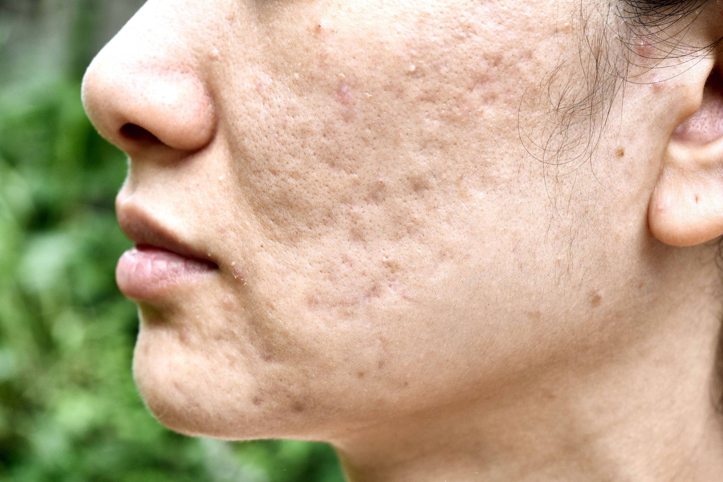 Rotina de Skincare Natural para Pele Adulta com Tendência à Acne