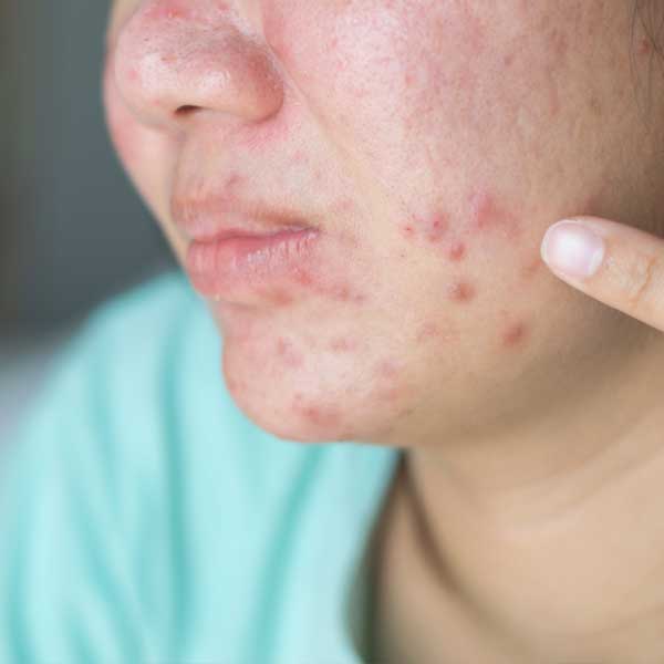 Guia Completo de Alimentação para Pele com Acne