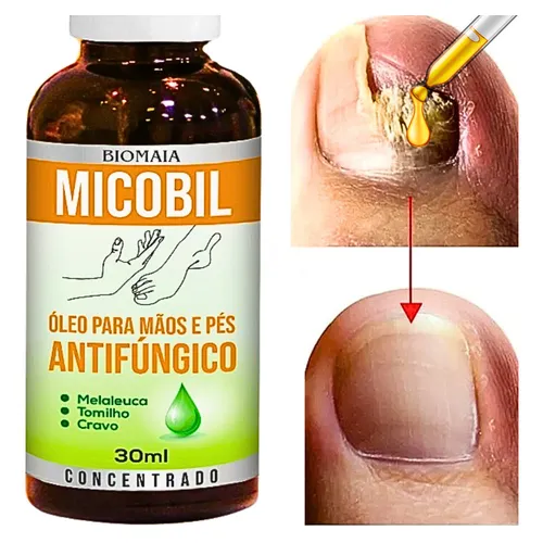 Como Usar Óleo de Melaleuca para Tratar Fungos nas Unhas