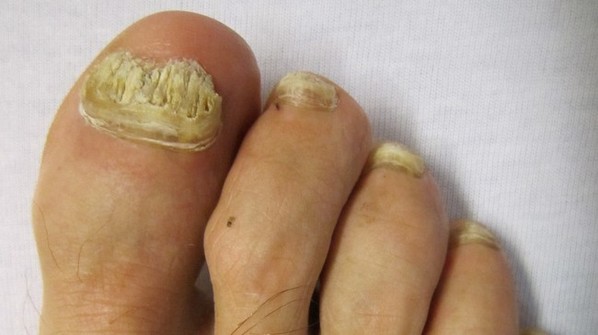 Vinagre de Maçã: O Aliado Secreto Contra a Micose