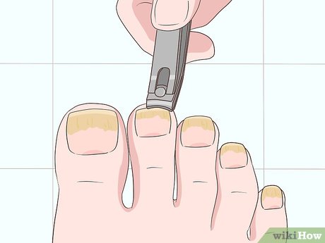 como tratar a micose de unha naturalmente