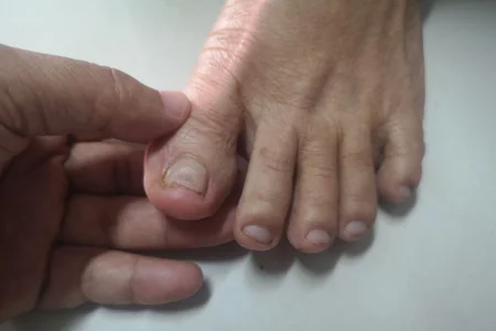 5 Remédios Caseiros Infalíveis para Micose de Unha