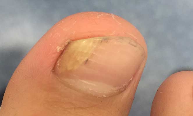 Como Usar Óleo de Melaleuca para Tratar Fungos nas Unhas