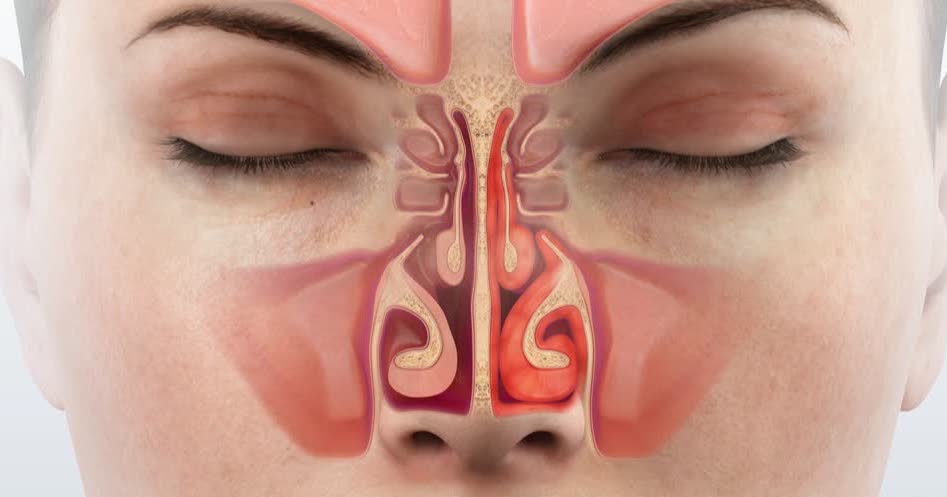 como tratar a rinite alérgica naturalmente