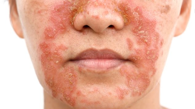 Alimentação e Dermatite Atópica: O Que Comer e o Que Evitar