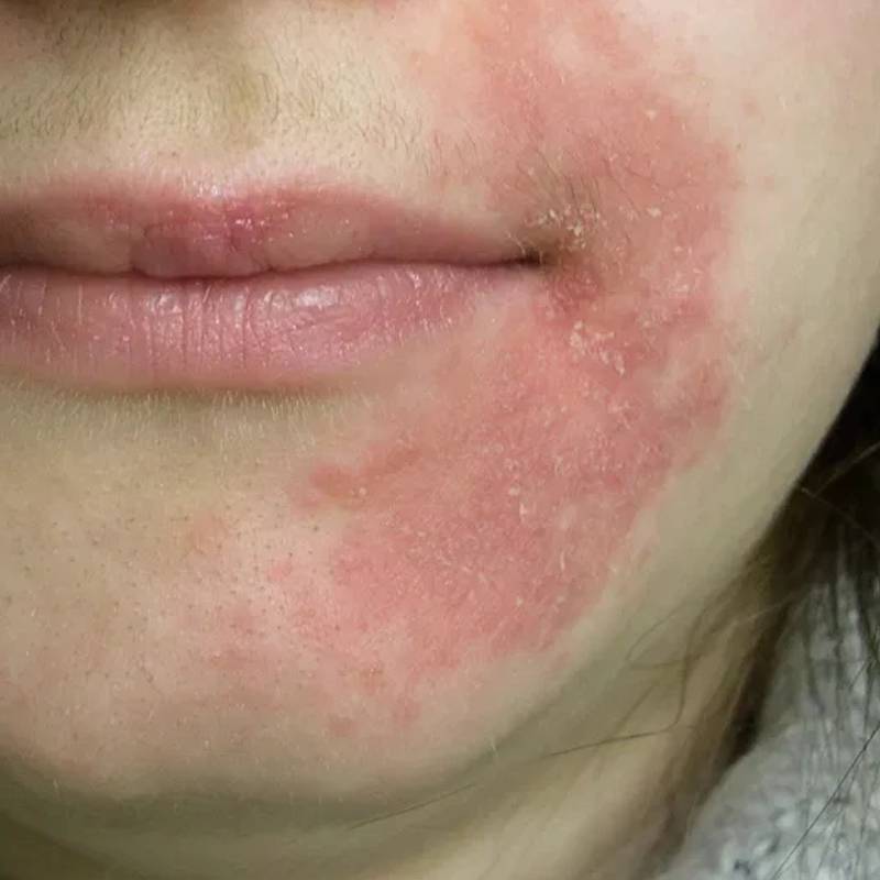 Receitas Caseiras para Aliviar a Coceira da Dermatite no Rosto