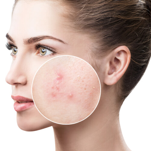 5 Ingredientes Essenciais para Combater a Acne Interna