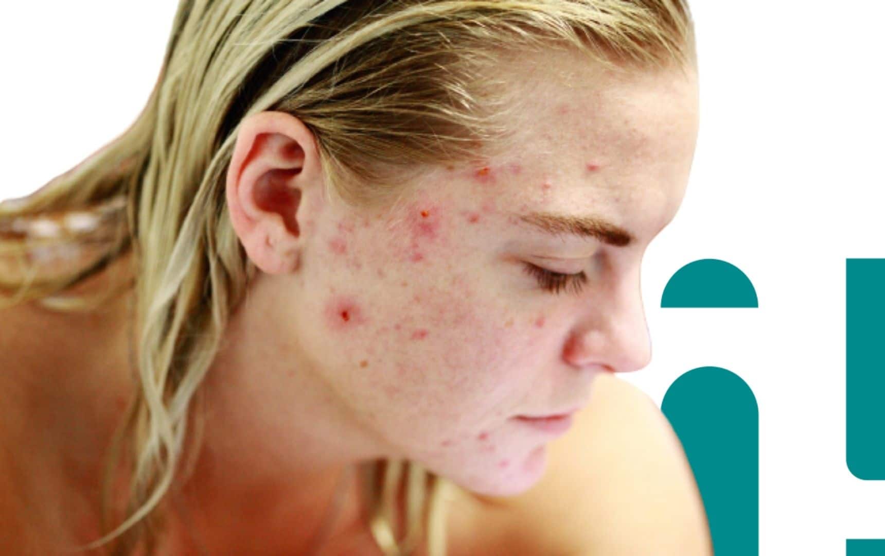 Como Usar Calor e Gelo para Aliviar Espinhas Dolorosas