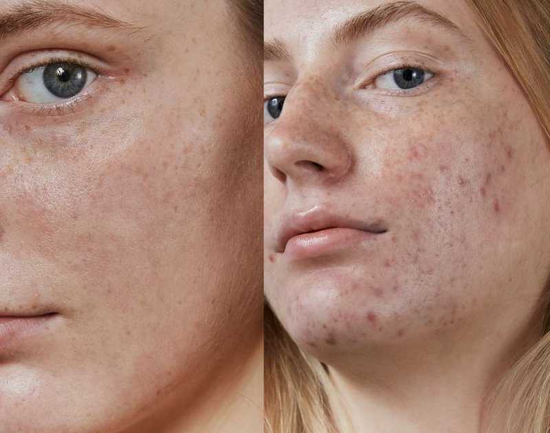 O Papel da Hidratação na Pele Acneica: Evitando o Efeito Rebote