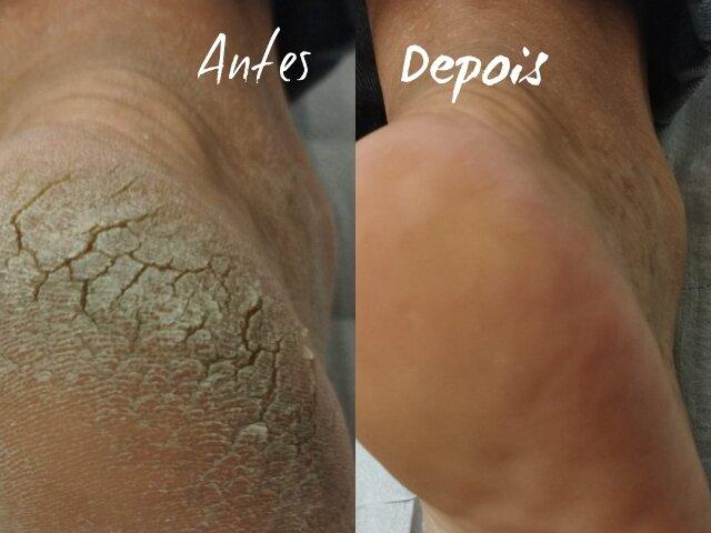 como tratar o calcanhar rachado naturalmente