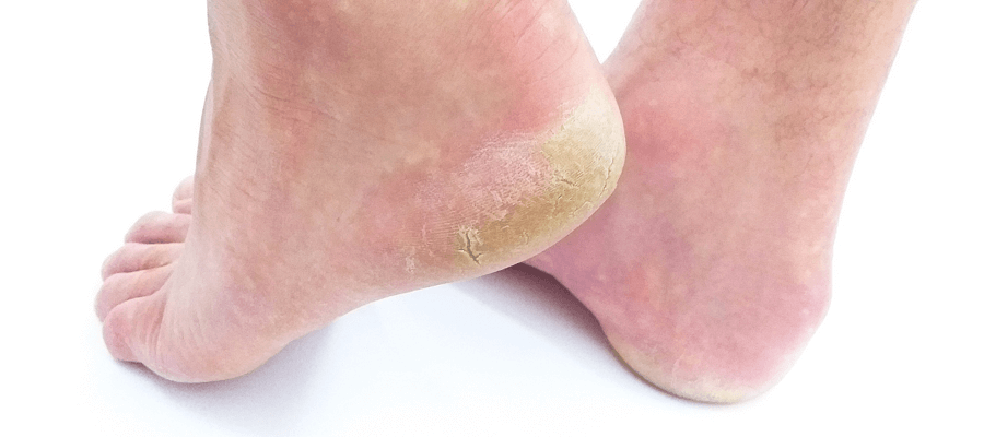 Os Benefícios do Óleo de Coco para Pés Rachados: Um Guia Completo