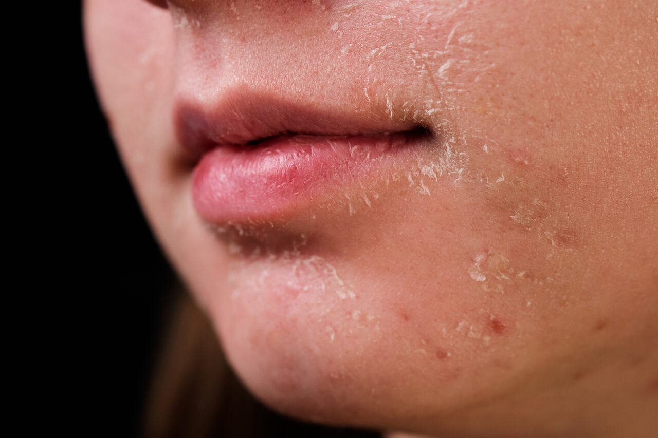 Os Melhores Hidratantes com Ceramidas para Pele Descamando