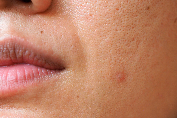 Guia Completo de Ácidos para o Rosto