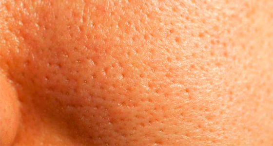 O Que é Microagulhamento e Seus Benefícios