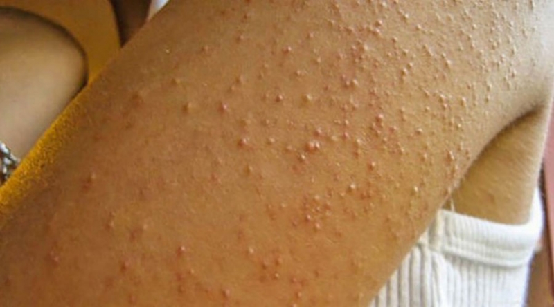 Os Melhores Cremes com Ureia para Queratose Pilar