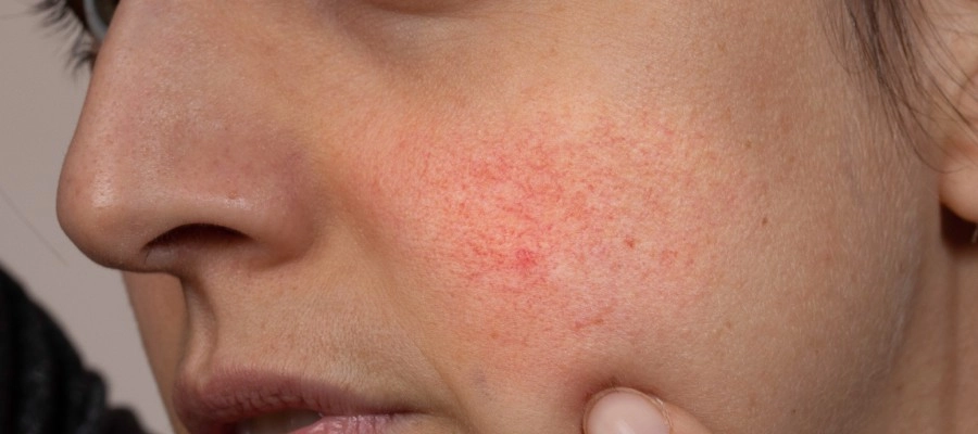 Como Usar Mel para Hidratar e Acalmar a Pele