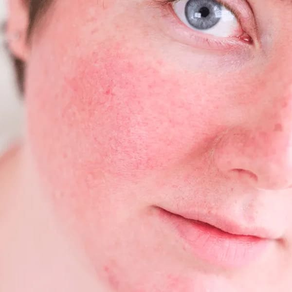 A Importância da Água Termal para Peles Sensíveis