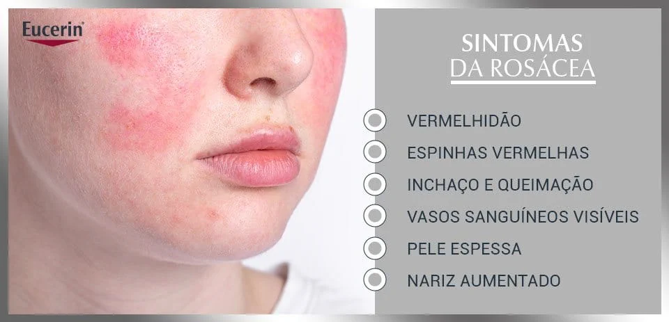 como tratar vermelhidão no rosto naturalmente
